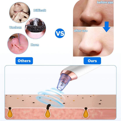 2022 Blackhead Remover Pore Vacuum, USB Rechargeable Acne Comedone Whitehead Extractor for Women & Men